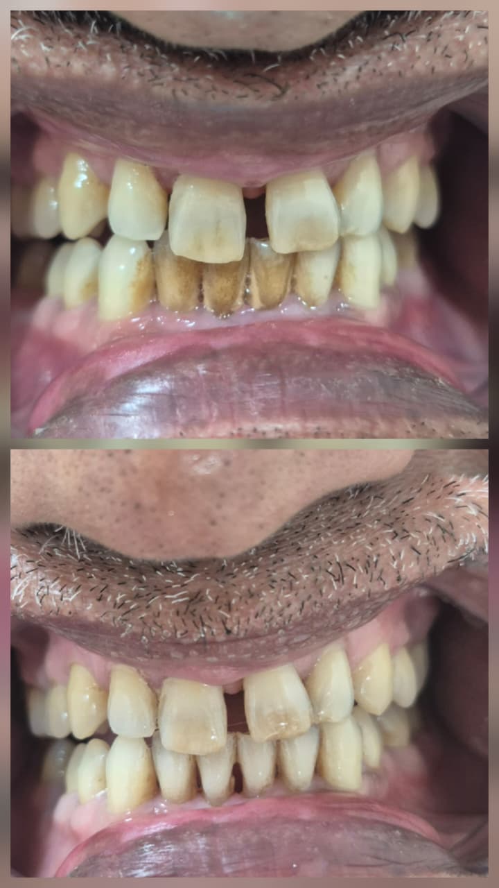 Before and after smile transformation 3